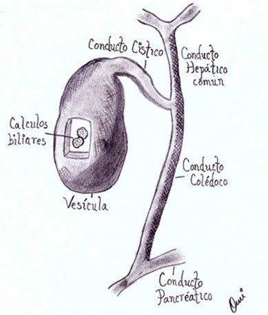 Colecistitis Crónica Litiásica - Médico Gastroenterólogo CDMX - Cirugía ...